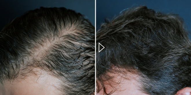 Мезотерапия кожи головы - фото до и после