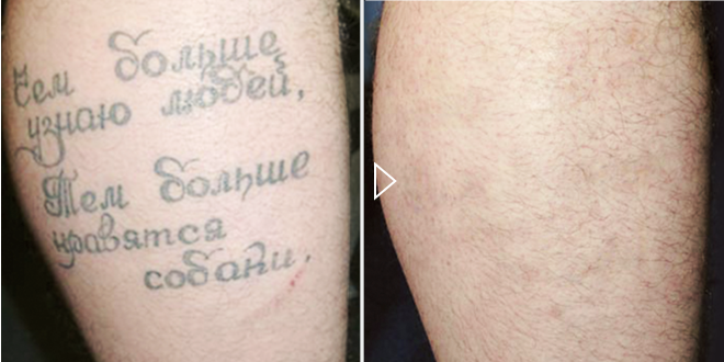 Удаление татуировок лазером - фото до и после