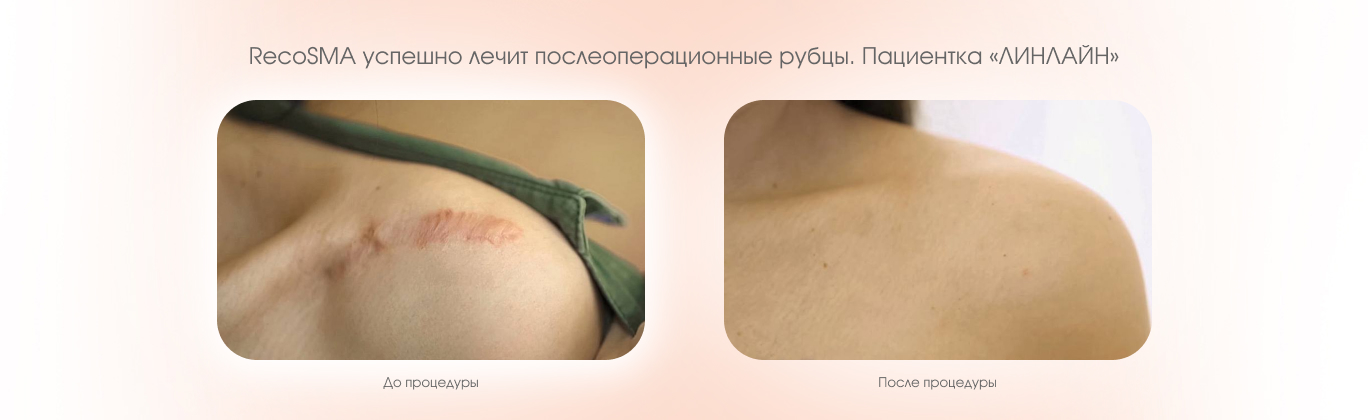 Лечение послеоперационных рубцов