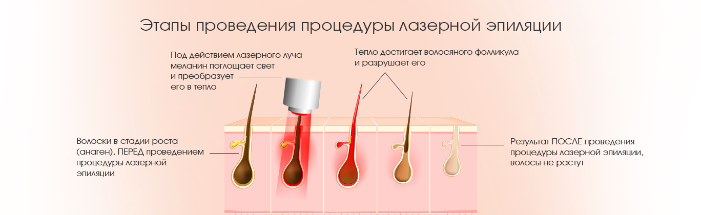Лазерная эпиляция