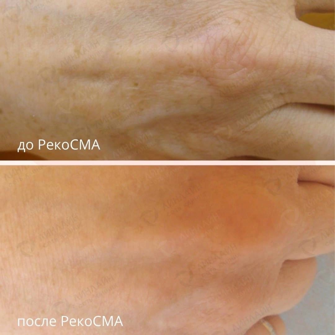 Омоложение кистей