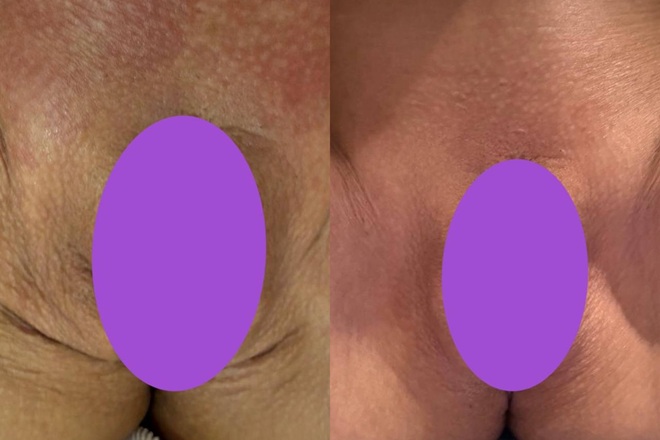 Интимное омоложение