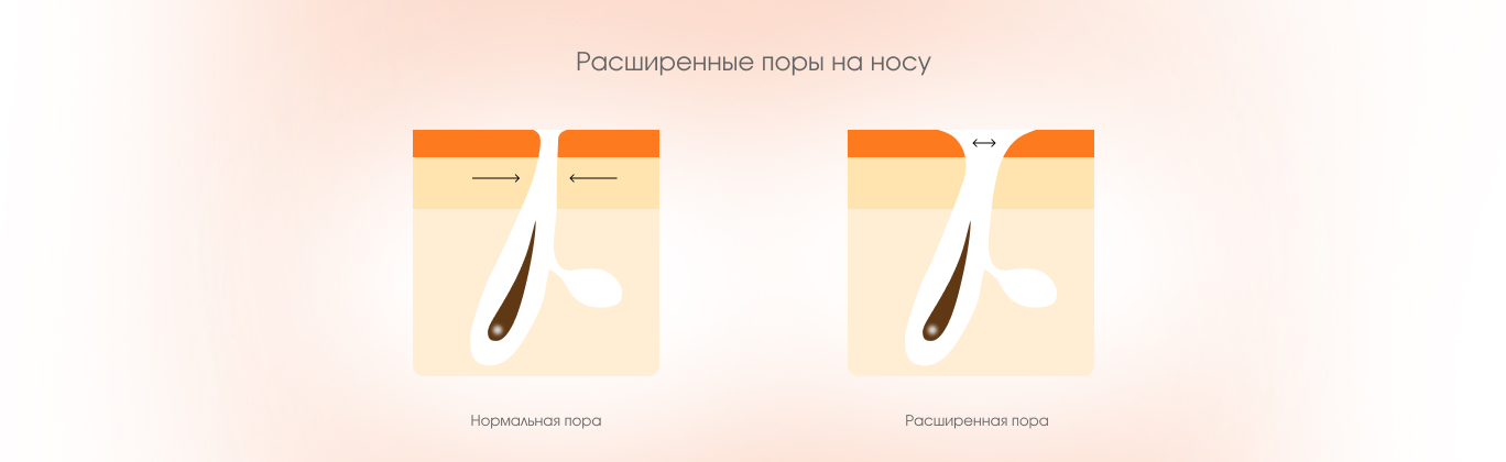 Нормальная и расширенная пора на носу