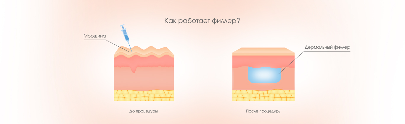 Филлеры