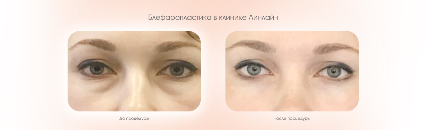 Лазерная блефаропластика