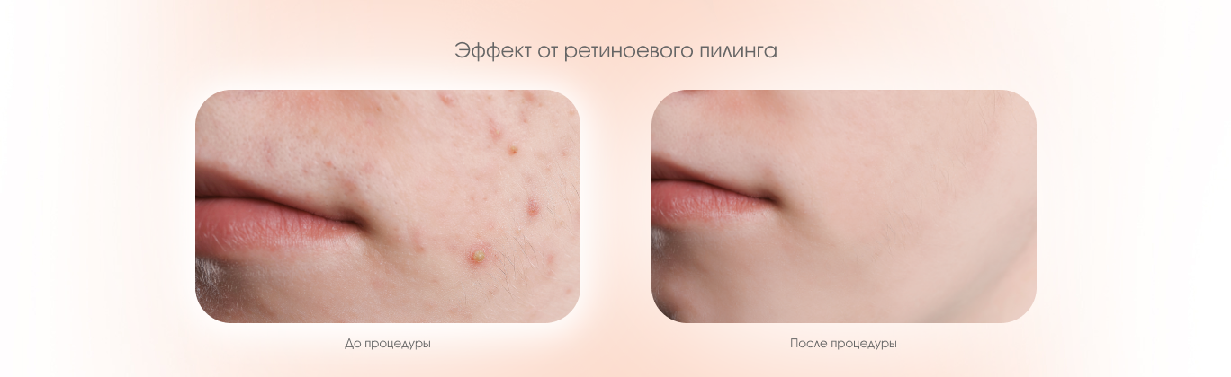 Ретиноевый пилинг
