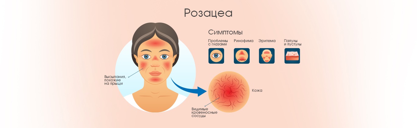 Розацеа