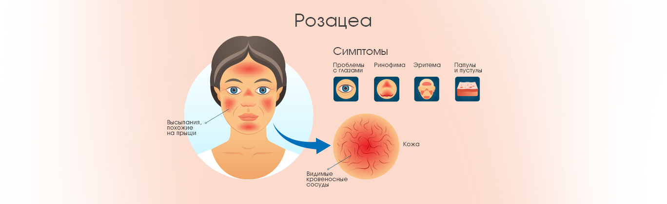Розацеа