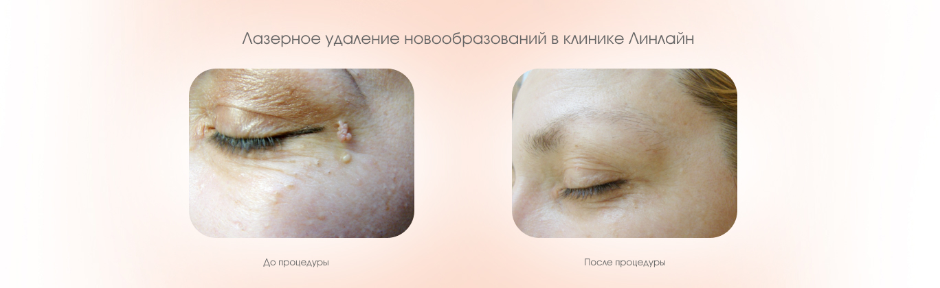 Лазерное удаление новообразований