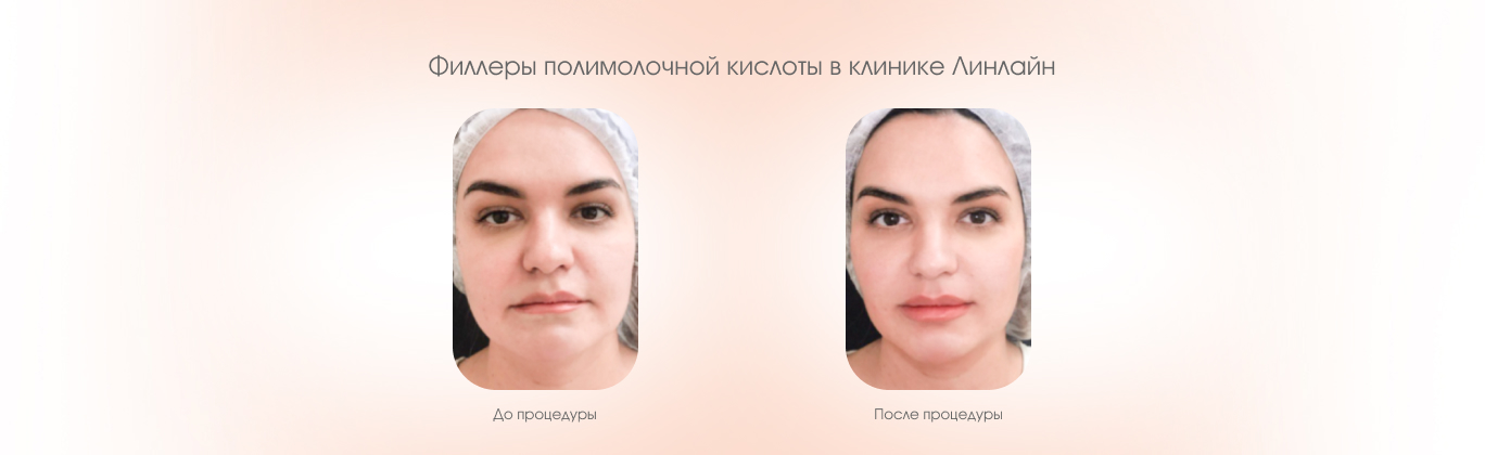 До и после процедуры