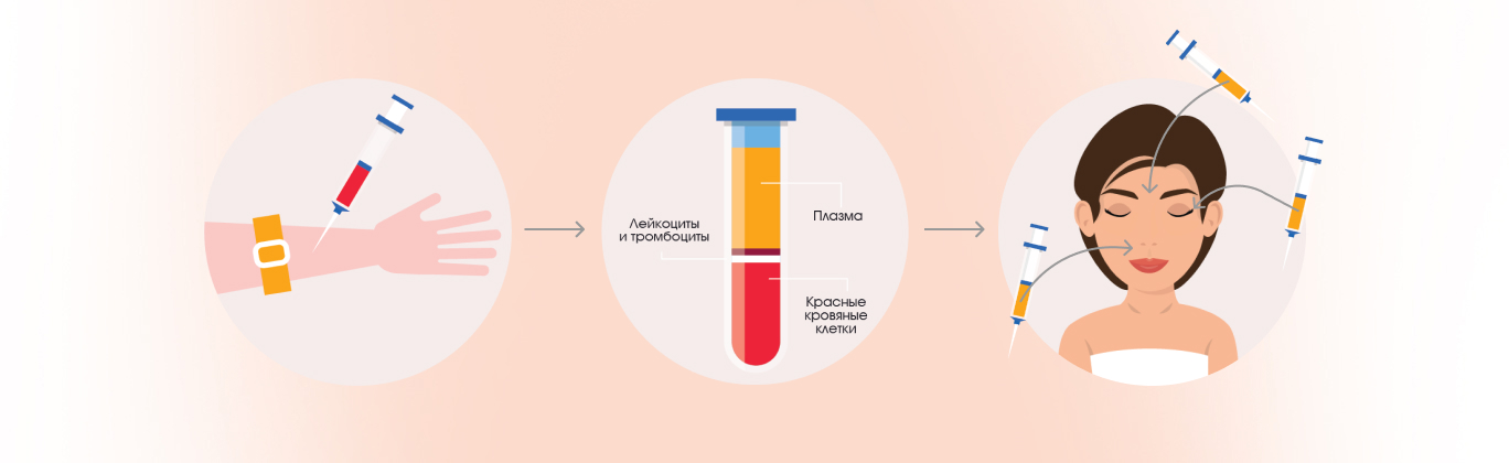 Процедура плазмолифтинга