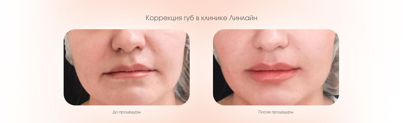 Коррекция губ