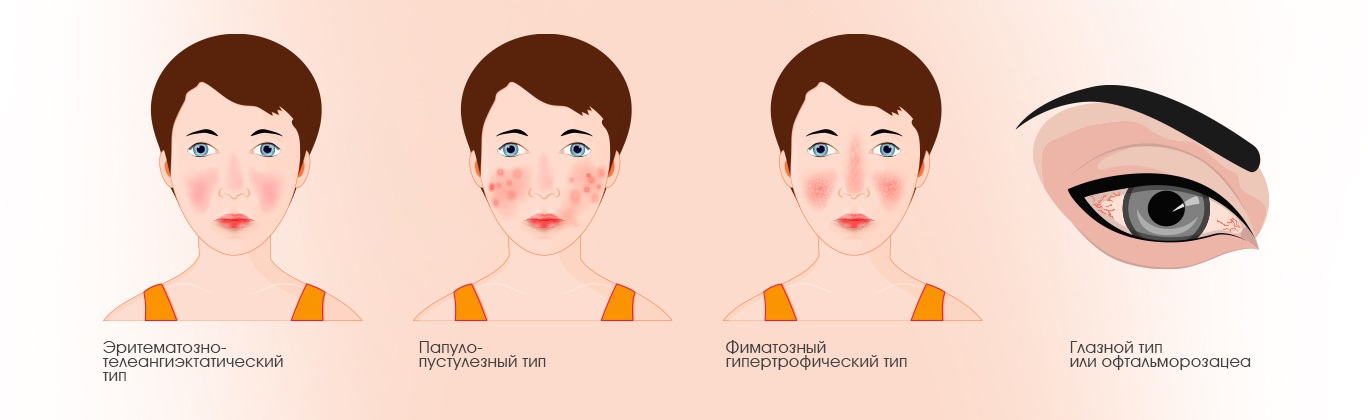 Классификация