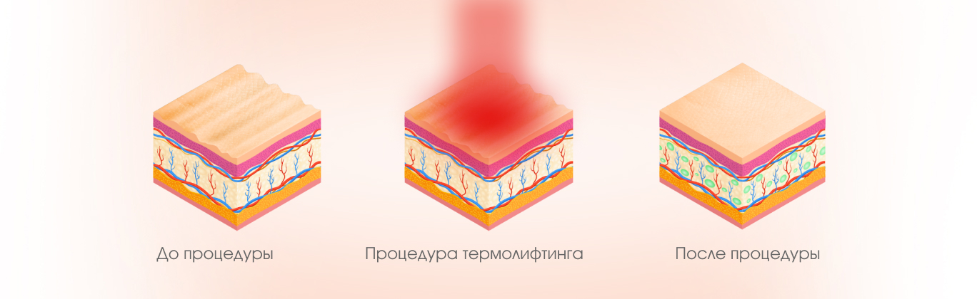 Термолифтинг