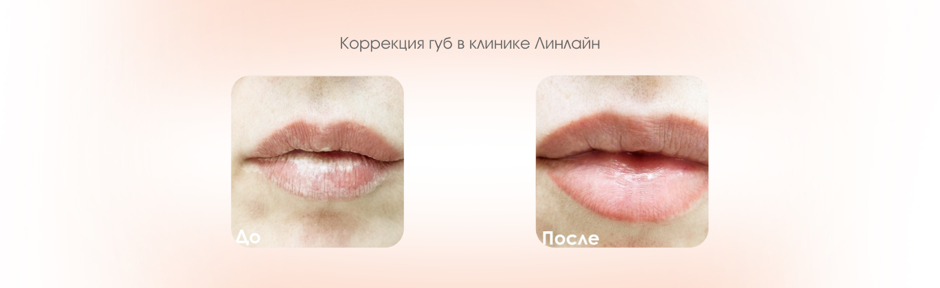 Коррекция губ