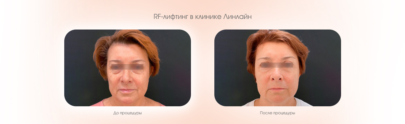 RF-лифтинг лица
