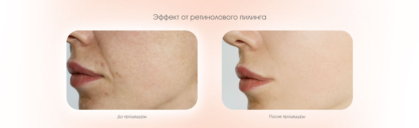 Ретиноловый пилинг