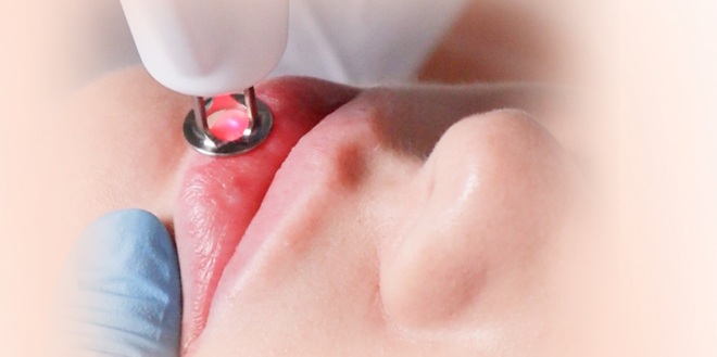 Омоложение губ