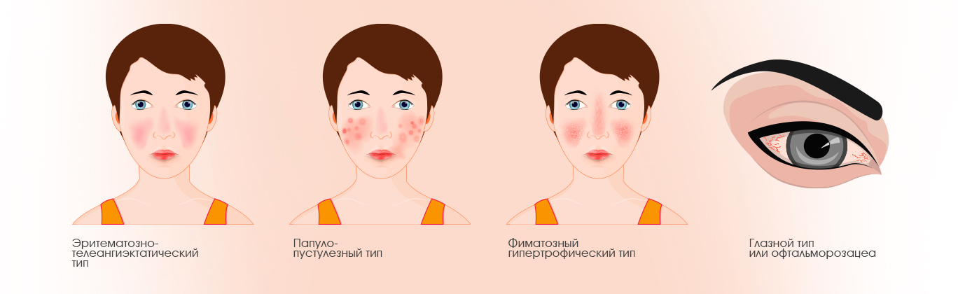 Розацеа
