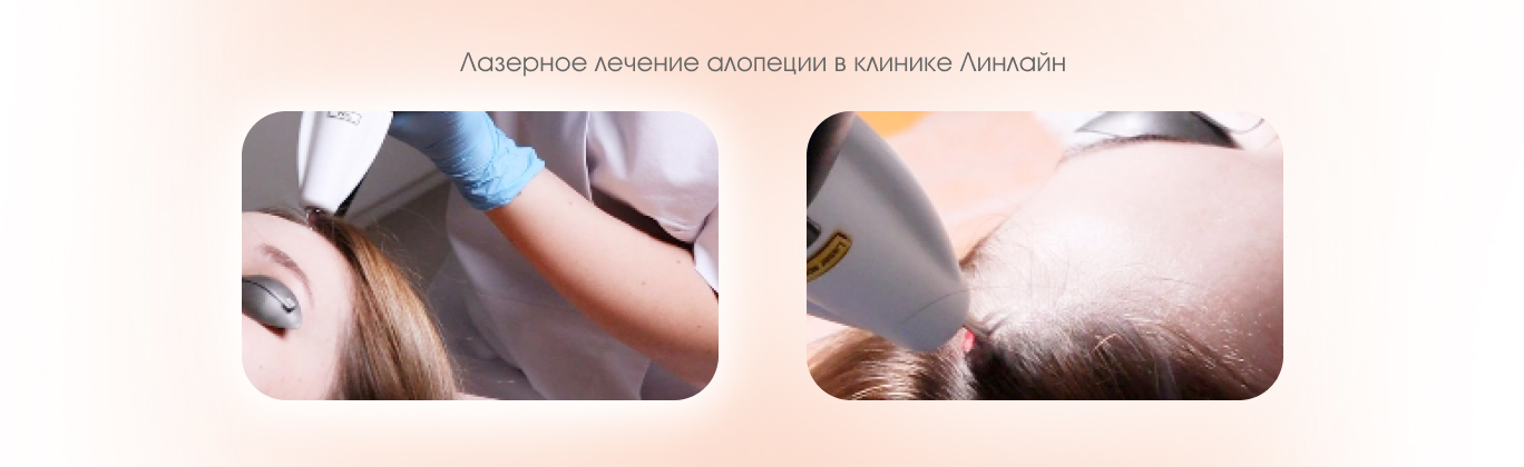 Лечение алопеции