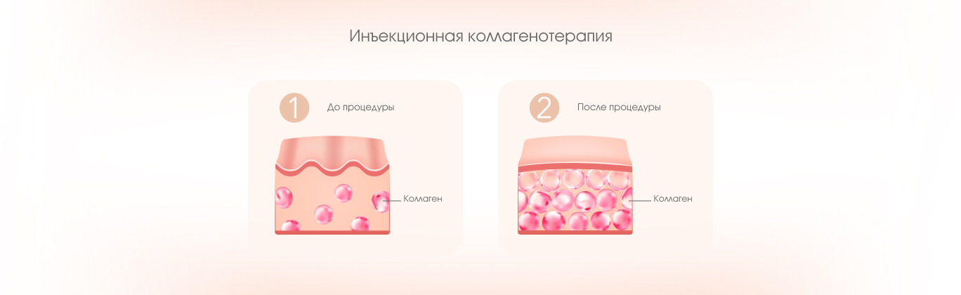 Инъекционная коллагенотерапия