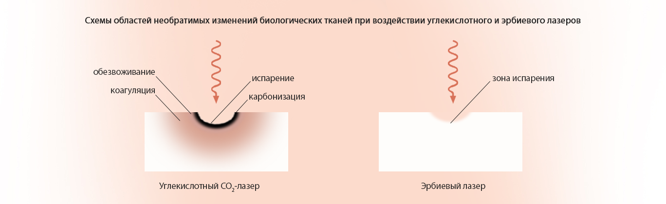 Преимущества эрбиевого лазера