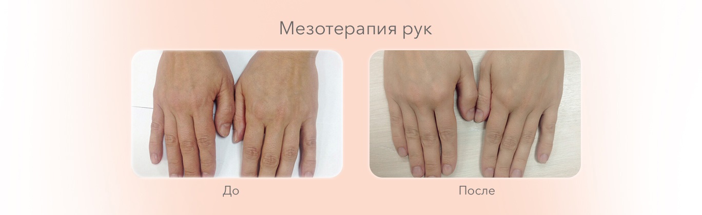 Мезотерапия рук