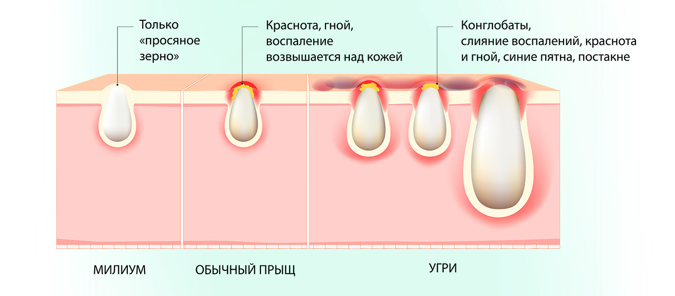 Милиумы