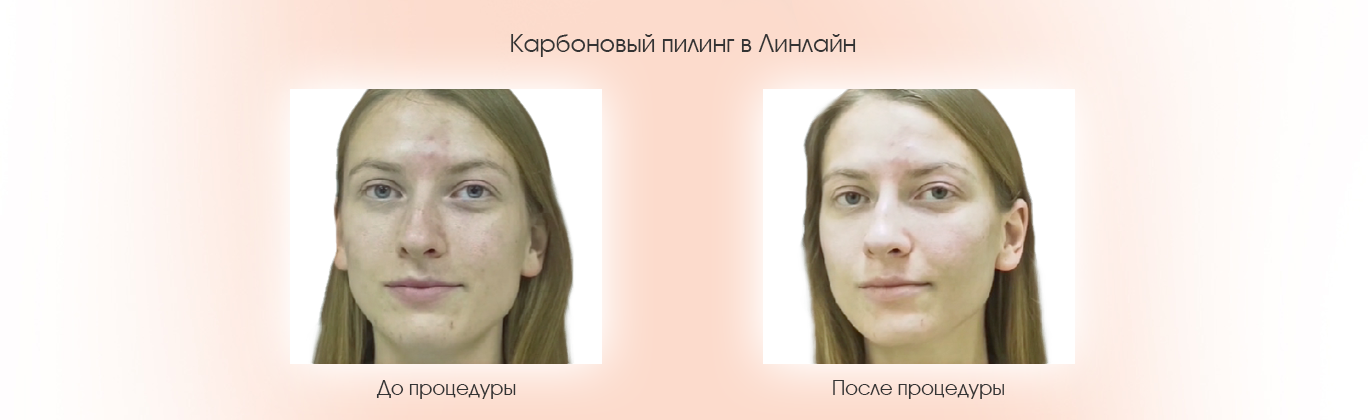 Результаты карбонового пилинга