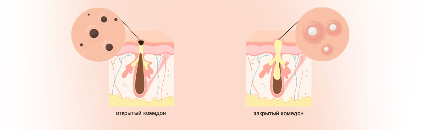 Комедоны