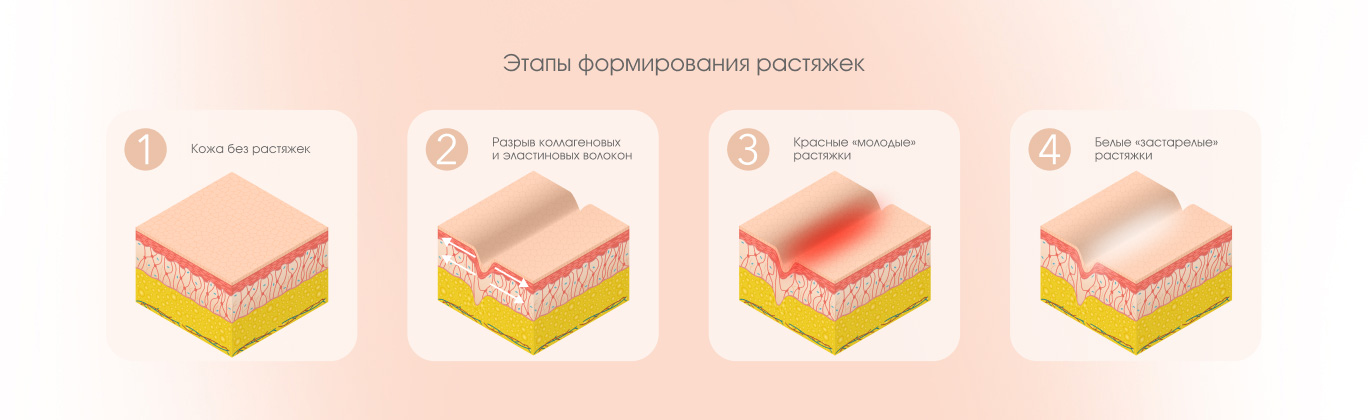 Этапы формирования растяжек