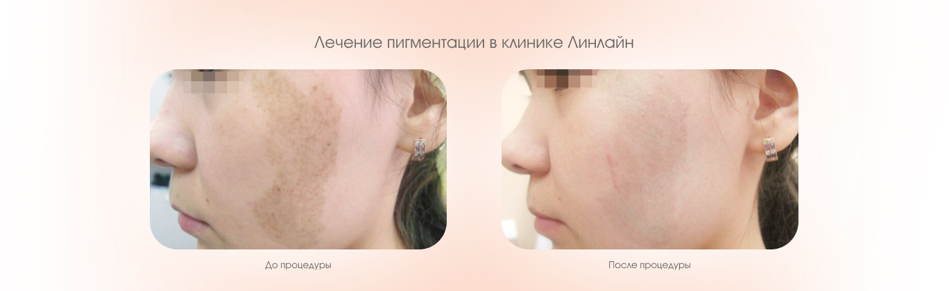 Лечение пигментации
