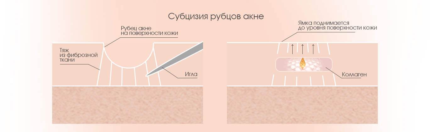 Субцизия