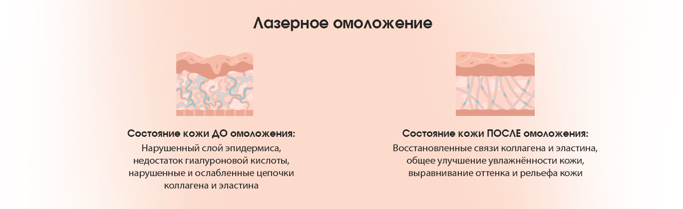 Лазерное омоложение