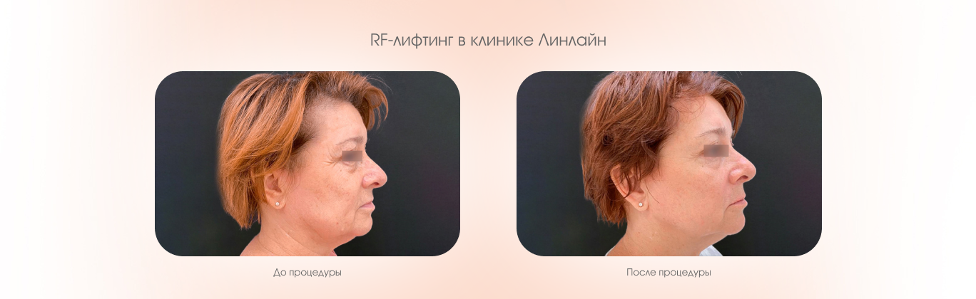RF-лифтинг
