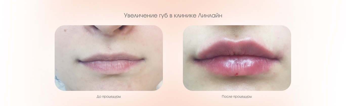 Увеличение губ