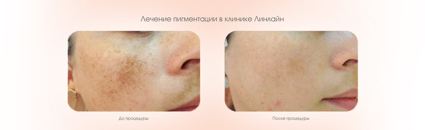 До и после процедуры