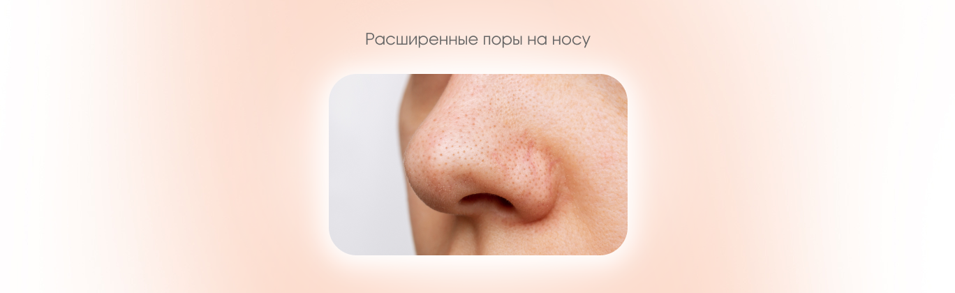 Расширенные поры на носу