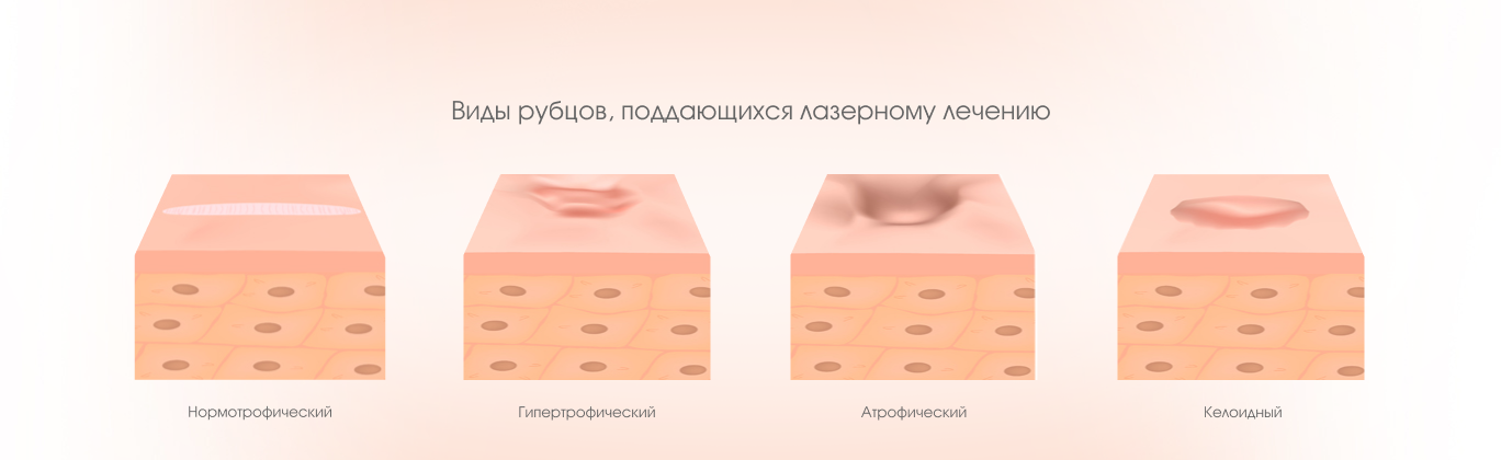 Виды рубцов