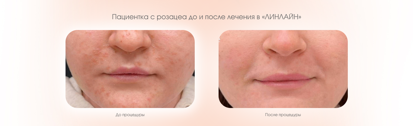 До и после процедуры