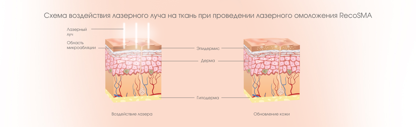Воздействие лазерного луча на ткань
