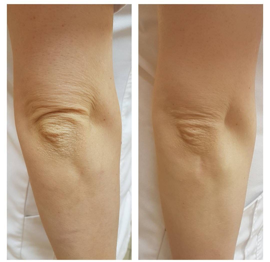 Омоложение локтей