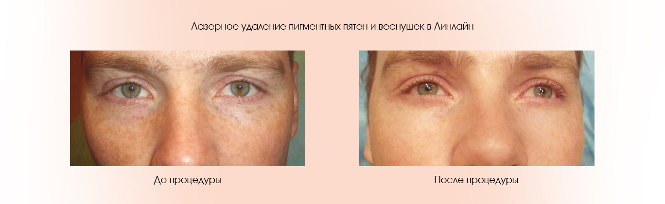 лечения постакне у мужчин
