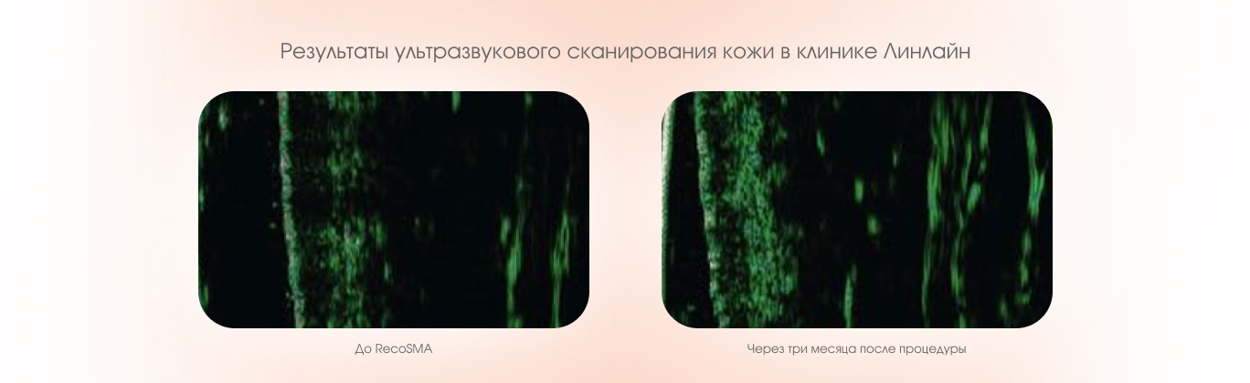 Ультразвуковое сканирование кожи до и после RecoSMA