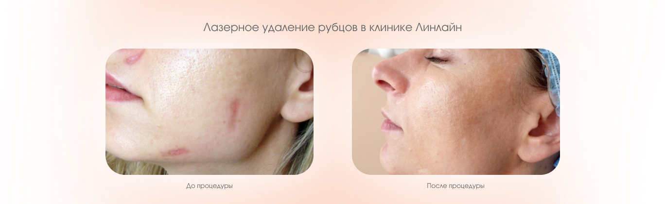 Удаление шрамов