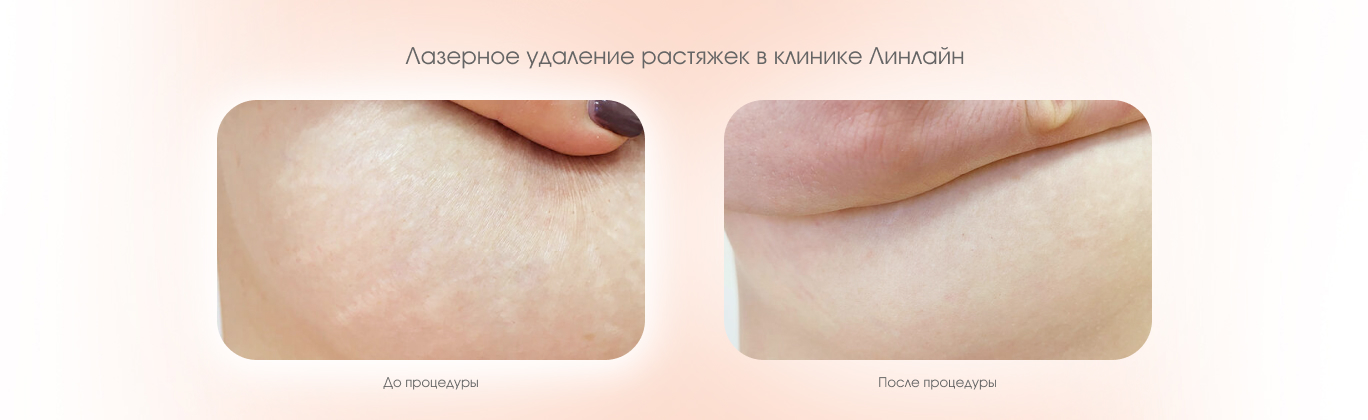 Удаление растяжек