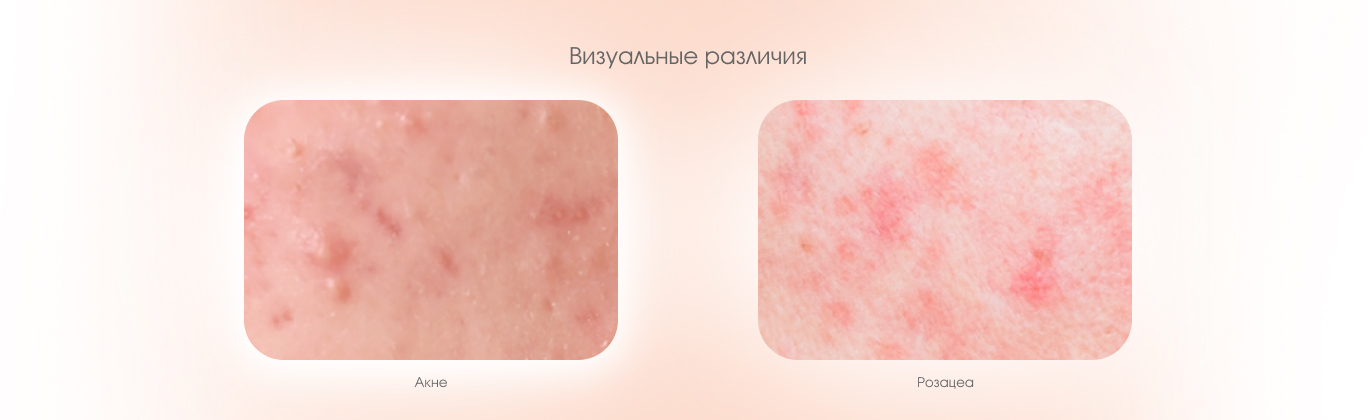 Различия между акне и розацеа