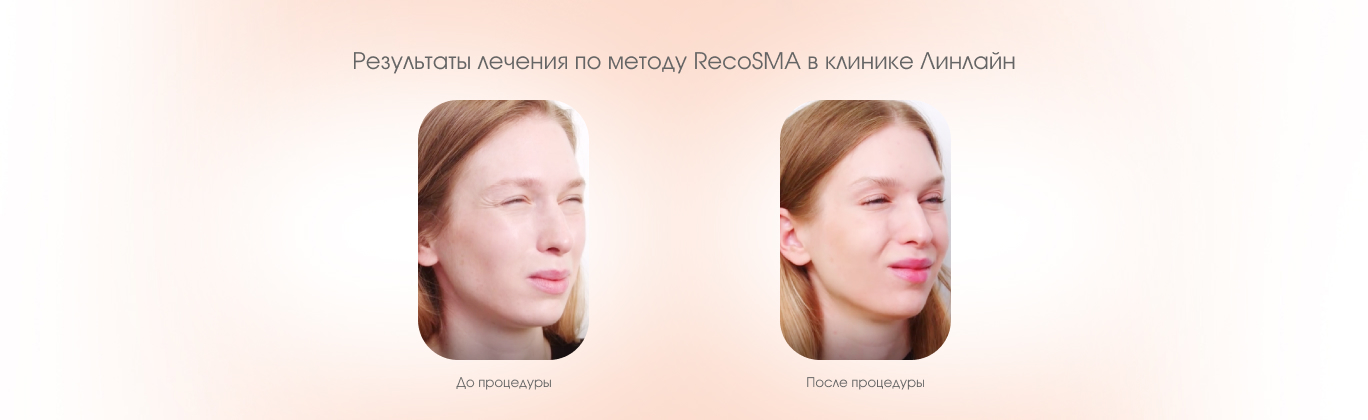 RecoSMA