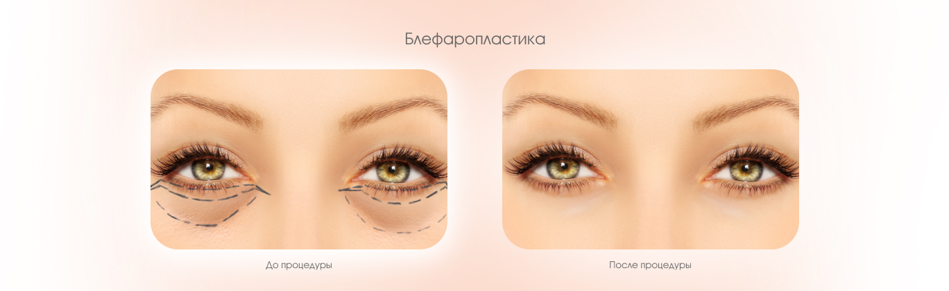 Блефаропластика