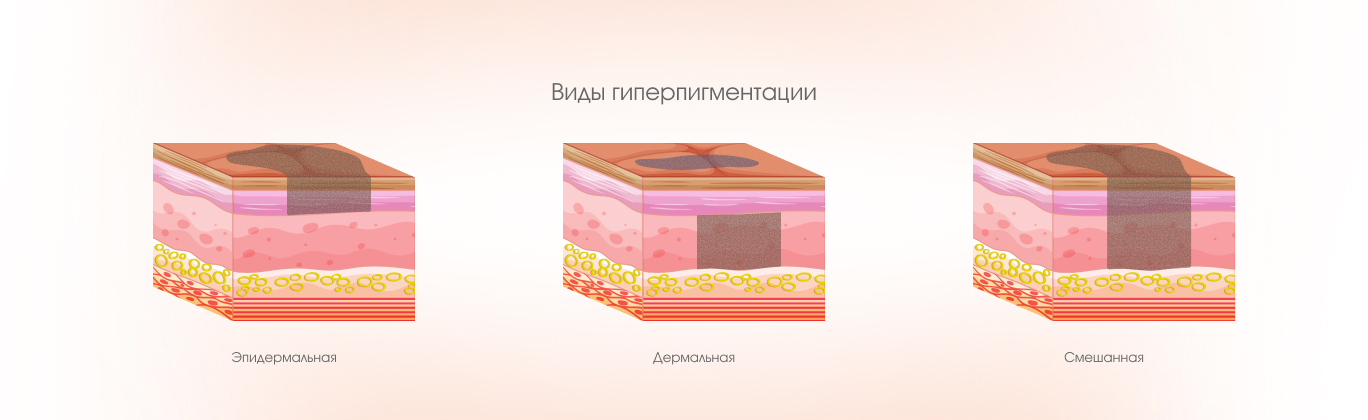 Виды гиперпигментации